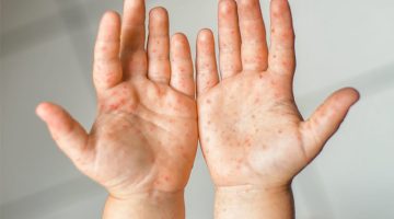 أعراض متلازمة اليد والقدم والفم