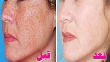 مكون سحري في مطبخك يخلصك من البثور والحبوب والتصبغات الجلدية بشكل سريع