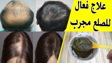 وصفة سحرية وفعالة لعلاج تساقط الشعر والثعلبة وفراغات الشعر بمكونات من منزلك