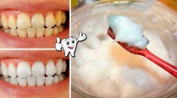 تنظيف الاسنان بالكربونات
