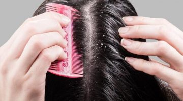 وصفات مجربة للتخلص من قشرة الشعر