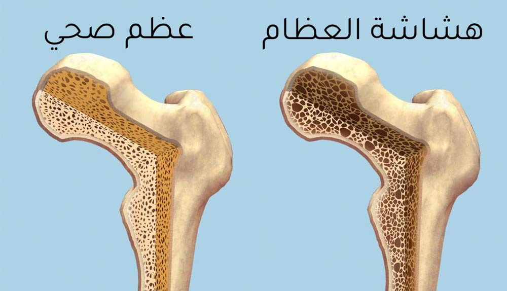 التخلص من هشاشة العظام وفقدان الوزن وعلاج الإمساك بشكل سريع جداً